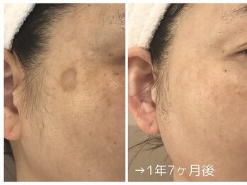 ビューティーサロン メイプルツリーの写真/美肌コンテスト3年連続受賞★シミ・シワ改善で理想のノーファンデ肌へ♪◎