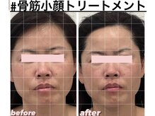 エースマイルイズ(A smile is..)/1回で驚きの小顔！