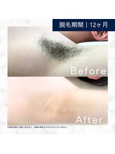 メンズクリア 大阪梅田店/【メンズクリア】お客様の施術例