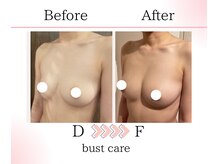 サロンツキ(salon tuki)/バストアップ/バストケア症例