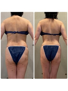 エクセレントビューティーサロン 艶(EN)/減量プログラム　6ｋｇ減量　