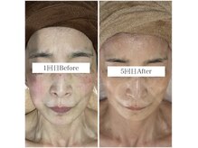 最新光フォト/シミ、シワ、たるみ/オーダーメイド