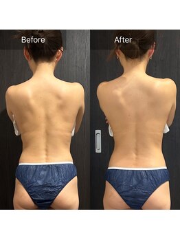 ルネアススパ 南青山(Lune’as Spa)/《WINBACK》背中