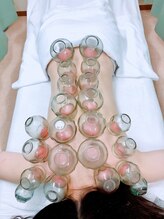 たくみ整体院/吸い玉