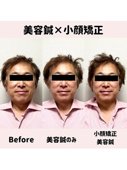 ワッカ 広尾(WACCA)/美容鍼×小顔矯正BeforeAfter 6