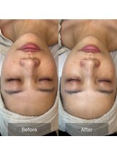 プロット 大阪本店(plot)/LDM・ララピール 施術　