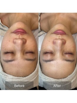 プロット 大阪本店(plot)/LDM・ララピール 施術　