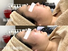 キーオブフェイス(Key of Face)/お悩み【2重顎】