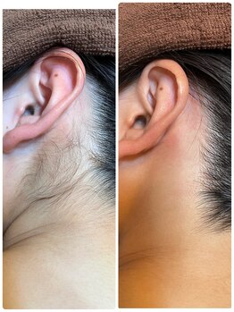 ノノ(nono)/うなじ～えりあし脱毛