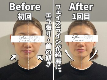 鍼灸整体院ユー(鍼灸整体院You...)/美容鍼×小顔矯正　施術後の変化