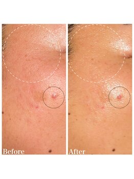 ココ(COCO)/ハーブピーリング/REVI /高知