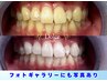 人気NO.1☆【1日でできる限界の白さへ★】業界最長15分×4照射で圧倒的効果♪