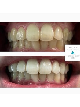 プラチナムビューティー 横須賀店/ビフォーアフター