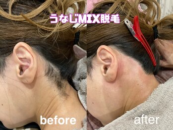 ルーク(RuCu)/うなじMIX脱毛