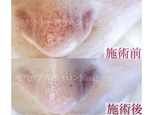 毛穴ケア専門店の雰囲気(ハンドマッサージと機器でしっかりとアプローチ【毛穴ケア】)