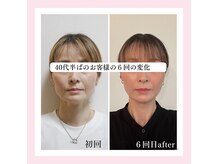 ル フラーズ(Les Fleurs)の雰囲気（スタッフ施術 エラ張りの変化深く入ってしまったほうれい線）
