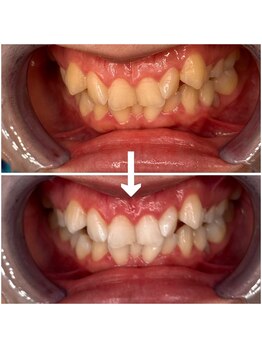エクシアホワイトニング 代々木店/ビフォーアフター　代々木/新宿
