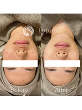 ルプレ(Lupure)/ハーブピーリング６回目