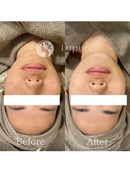 ルプレ(Lupure)/ハーブピーリング6回目