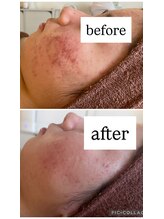 キコ リラクゼーションサロン(KICO by PLUS)/肌質改善フェイシャル