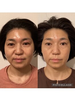 甲陽園鍼灸わたぐも/before→after