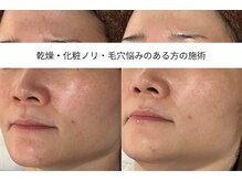 アイリス(iris)/人気◎肌に優しい角栓ケア付き