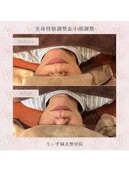 うぃず鍼灸整骨院/【施術例１】