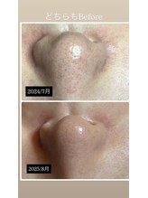 リンカ(Rinca)/一年後の毛穴（どちらも施術前）