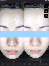 ウニ(uni)/オーダーメイド肌管理の症例です