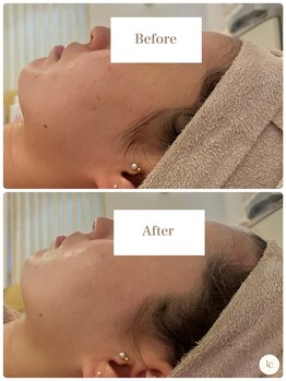 スキンセラピーサロン ル クレール(Le Clair)/Before→After