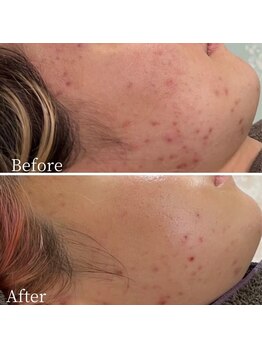 ニキビケア 毛穴研究所 立川店/顎ニキビや頬ニキビケアに!