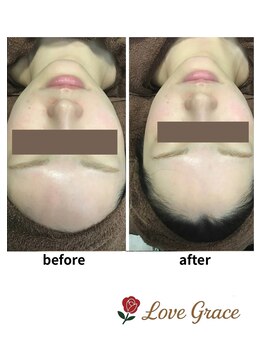 ラブグレイス(Lovegrace)/光フェイシャル