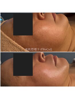 リセル 月島(ReCeLL)の写真/ホウレイ線/たるみ肉を一気に削ぎ落とす!KIWAMI RF・EMS・PO・IPL・サーマルフラクショナル×美容溶解