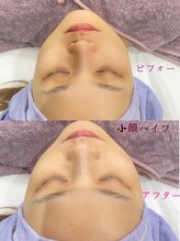エステティック シャララ(Sha la la)/ビフォーアフターのお写真