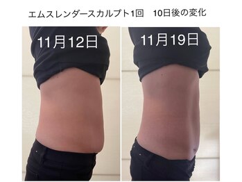ビューティーサロン ルクール エステ(beauty salon le Coeur Este)/エムスレンダー　Before・after