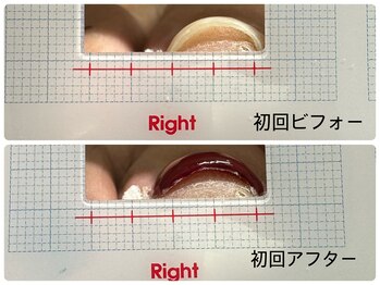 エヌスタイル(N-STYLE)/巻き爪ケア