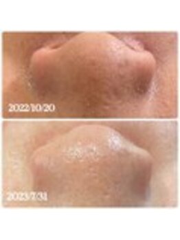 プローサム(Prorsum)/★松ヤニ効果★毛穴掃除★