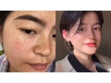 吉宗指圧治療院/ダイヤモンドピールbefore after