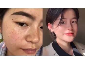 吉宗指圧治療院/ダイヤモンドピールbefore after