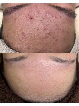 サロンドミュウ(Salon de Mieux)/【ニキビ】でお悩みのお客様