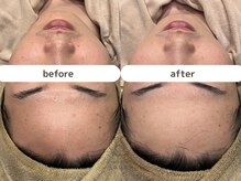 サンゴ(Sango)/毛穴黒ずみ/開き/ニキビ鎮静