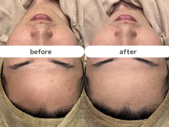 サンゴ(Sango)/毛穴黒ずみ/開き/ニキビ鎮静