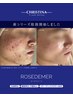 【肌の凹凸・ざらつきが気になる方】マリンピーリング〈剥離あり〉