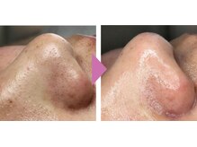 レイ エステティック 江南店(RAY ESTHETIC)/毛穴洗浄×顔脱毛