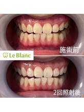 ルブラン 奈良店(Le Blanc)/初回の変化に驚き！