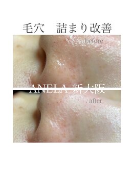 アネラ(ANELA)/毛穴エクストラクション症例