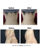 サマラボ 三軒茶屋(Sama Labo)/Before→After(脱毛)