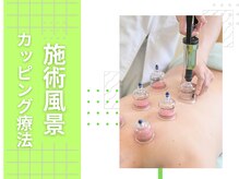 よし鍼灸接骨院 東花園院/カッピング(吸い玉)