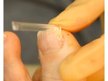 きりん接骨鍼灸院 尼崎武庫之荘店/巻き爪矯正～プレート装着