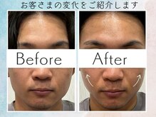 さくら鍼灸院 整骨院/美容鍼2